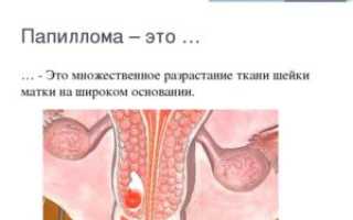 Папиллома шейки матки: симптомы, причины, методы лечения и удаления