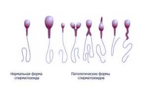 Патоспермия как признак бесплодия