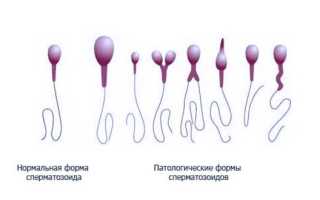Патоспермия как признак бесплодия
