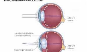 Что такое спазм аккомодации у ребёнка и как его лечить?