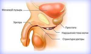Лечение уретрита у мужчин