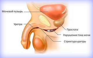 Лечение уретрита у мужчин