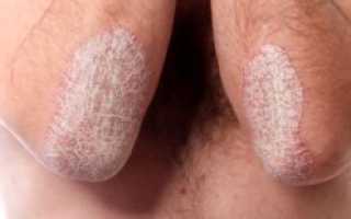 Высыпания на половых губах: виды пятен, причины, что является нормой, а что нет