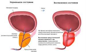 Воспаление простаты: симптомы и лечение