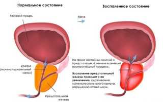 Воспаление простаты: симптомы и лечение