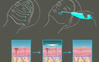 Технология воздействия дарсонвализации в лечебных и косметических целях