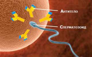Агглютинация сперматозоидов: как лечить опасный процесс