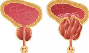 Признаки простатита у мужчин: симптомы простатита, причины и лечение