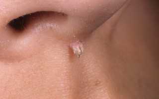 Инвертированная папиллома полости носа: характеристики, симптомы, диагностика