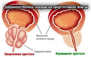 Аденома простаты у мужчин — симптомы и терапия заболевания