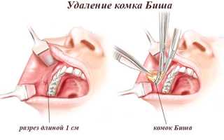 Удаление комков Биша: противопоказания, техника выполнения и результаты