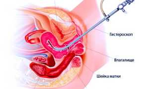 Гистероскопия перед ЭКО
