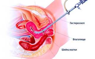 Гистероскопия перед ЭКО