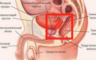 Везикулит у мужчин