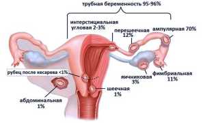 Может ли быть внематочная беременность при ЭКО?