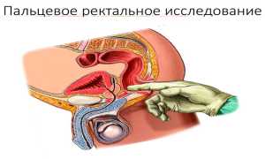 Чем грозит запущенный простатит мужскому здоровью — как предотвратить серьезное заболевание