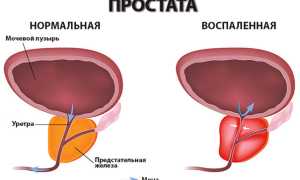 УЗИ простаты: как делается и подготовка к обследованию