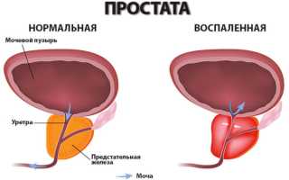 УЗИ простаты: как делается и подготовка к обследованию