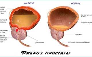 Что такое фиброз простаты, симптомы и лечение заболевания