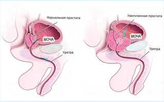 Все, что нужно знать об анализе ПСА у мужчин