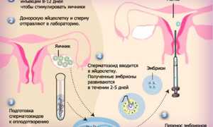 Эко с донорской яйцеклеткой