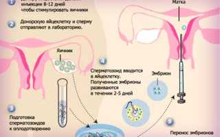 Эко с донорской яйцеклеткой