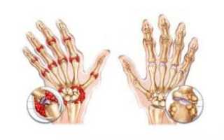 3 разновидности артроза кистей рук