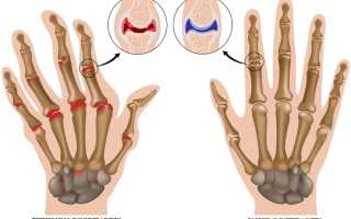 К какому врачу обращаться при болях в суставах пальцев рук и наростах
