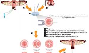 Чем ИКСИ отличается от ЭКО
