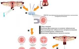 Чем ИКСИ отличается от ЭКО