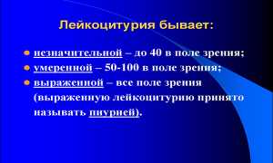 Причины пиурии — опасное заболевание для здоровья человека