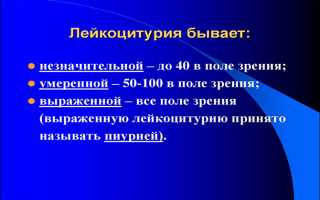 Причины пиурии — опасное заболевание для здоровья человека