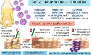 Вирус папилломы человека 51 типа: опасность, источник заражения, диагностика, профилактика, лечение