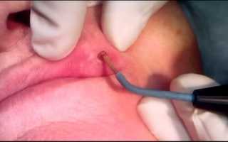 Папиллома на губе: диагностика и лечение