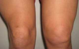 6 разновидностей синовита коленного сустава