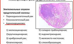 Аденокарцинома предстательной железы