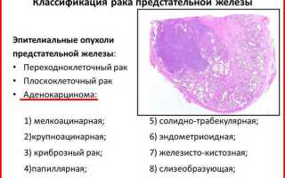 Аденокарцинома предстательной железы