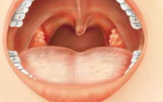 Папиллома в горле: причины, симптомы, диагностика, методы лечения