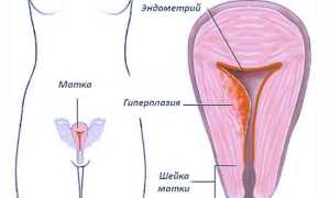 Гиперплазия эндометрия, лечение народными средствами