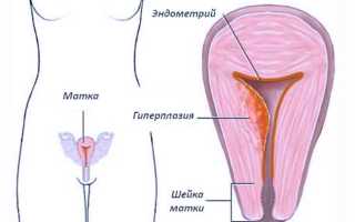 Гиперплазия эндометрия, лечение народными средствами