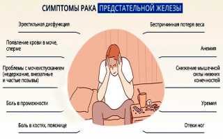 Рак простаты первой стадии — как предотвратить страшную болезнь