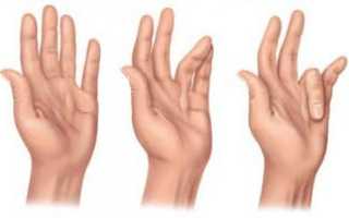 Болезнь Нотта МКБ-10: щелкающий палец руки у детей