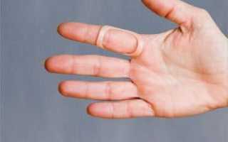 Стенозирующий лигаментит: лечение руки по методу Шастина