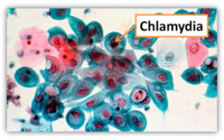 Хламидия трахоматис: что это такое и ее виды, источник заражения, опасность, симптомы,