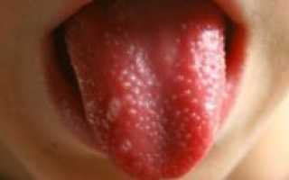 Кондиломы во рту и на языке: причины, симптомы, диагностика и лечение