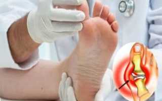 Методы лечения артроза большого пальца ноги