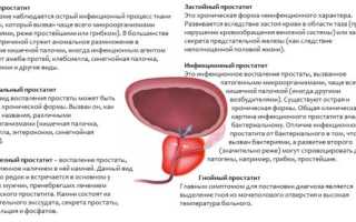 Как избежать простатита?