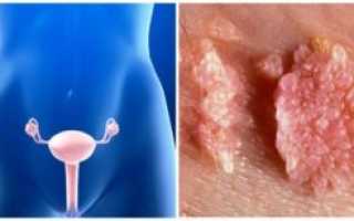 HPV инфекция у женщин: причины появления, опасность, симптомы, диагностика