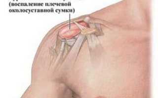 Причины развития каменного бурсита плечевого сустава