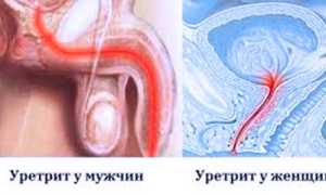 Лечение уретрита народными средствами